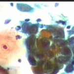 Ενδοτραχήλου κι ενδομητρίου στο επίχρισμα κατά Papanicolaou. Περιστατικά ιατρείου.